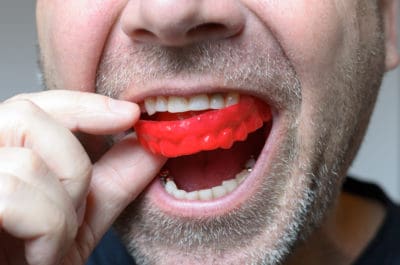 5 things you need to know about mouth guards