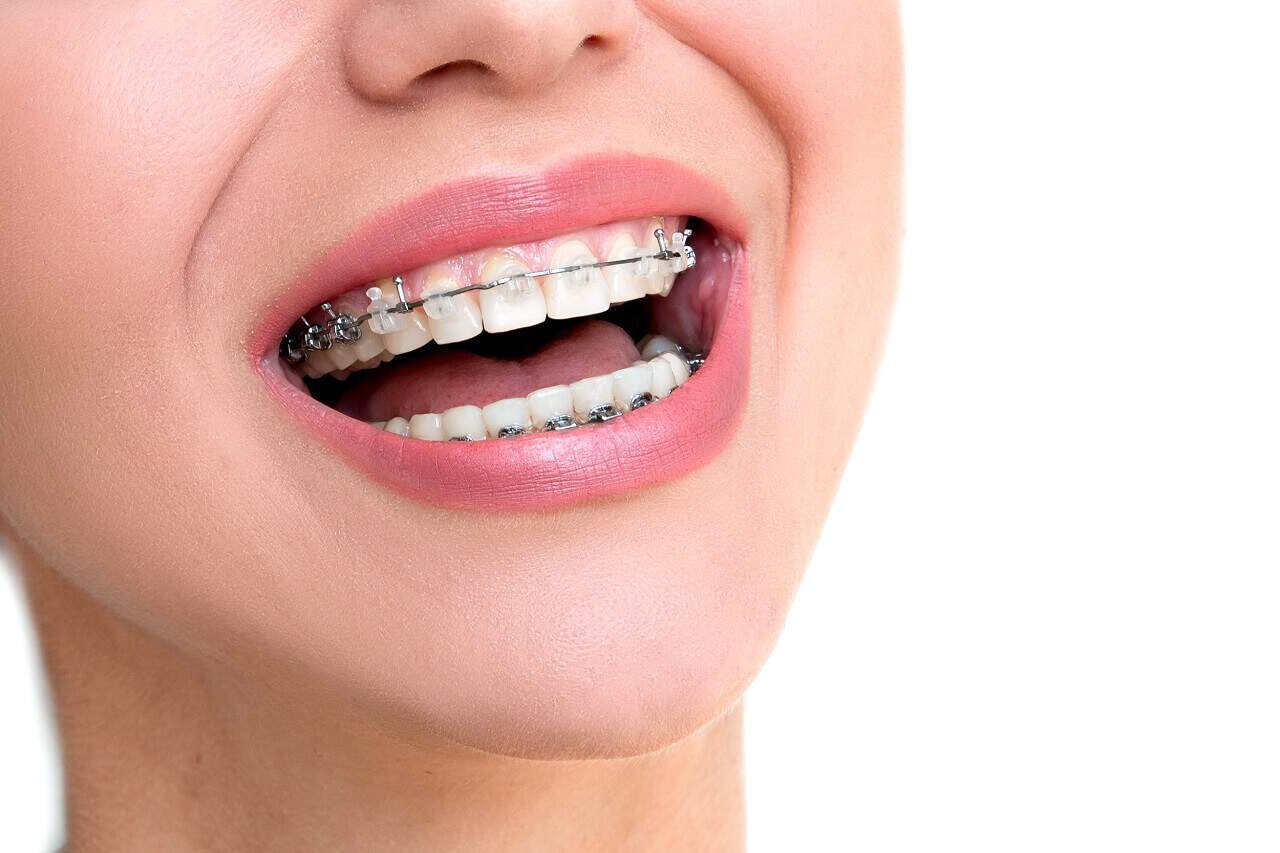 Straight Wire Braces for Straight Teeth