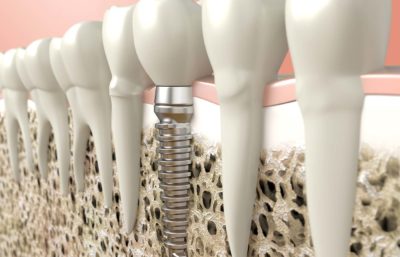 10 benefits of dental implants