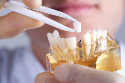 how to receive dental implants that fail