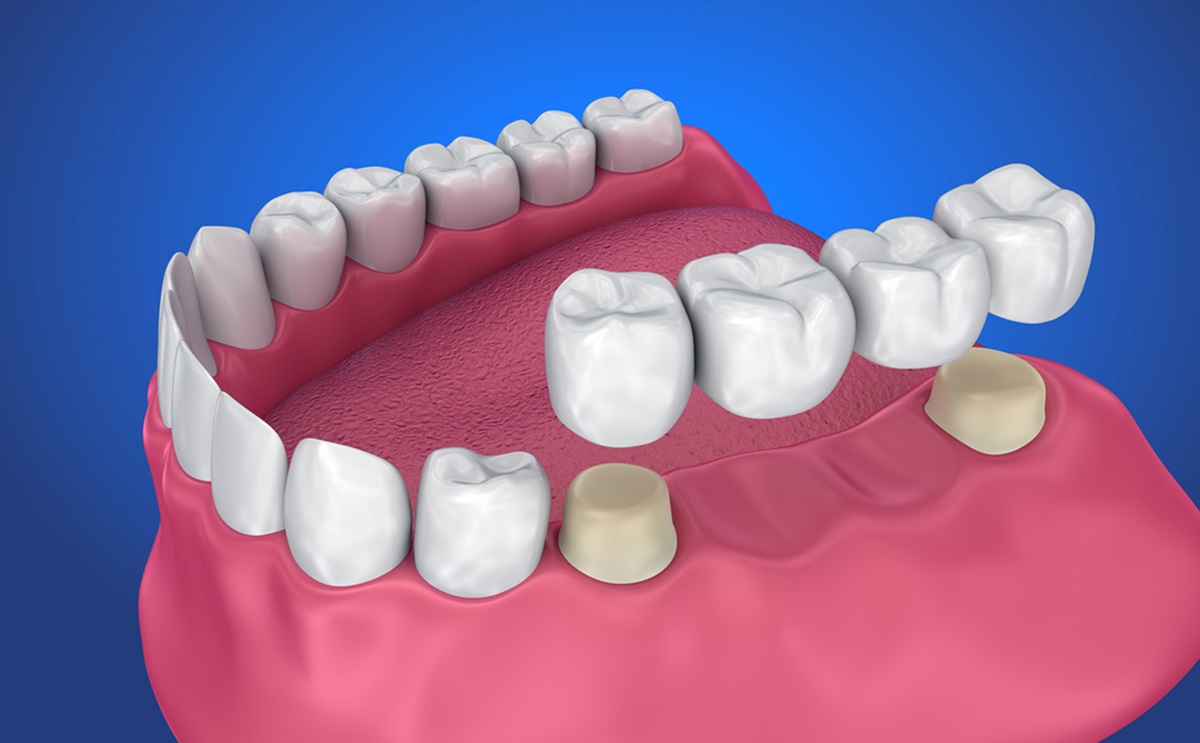 how patients can replace missing teeth