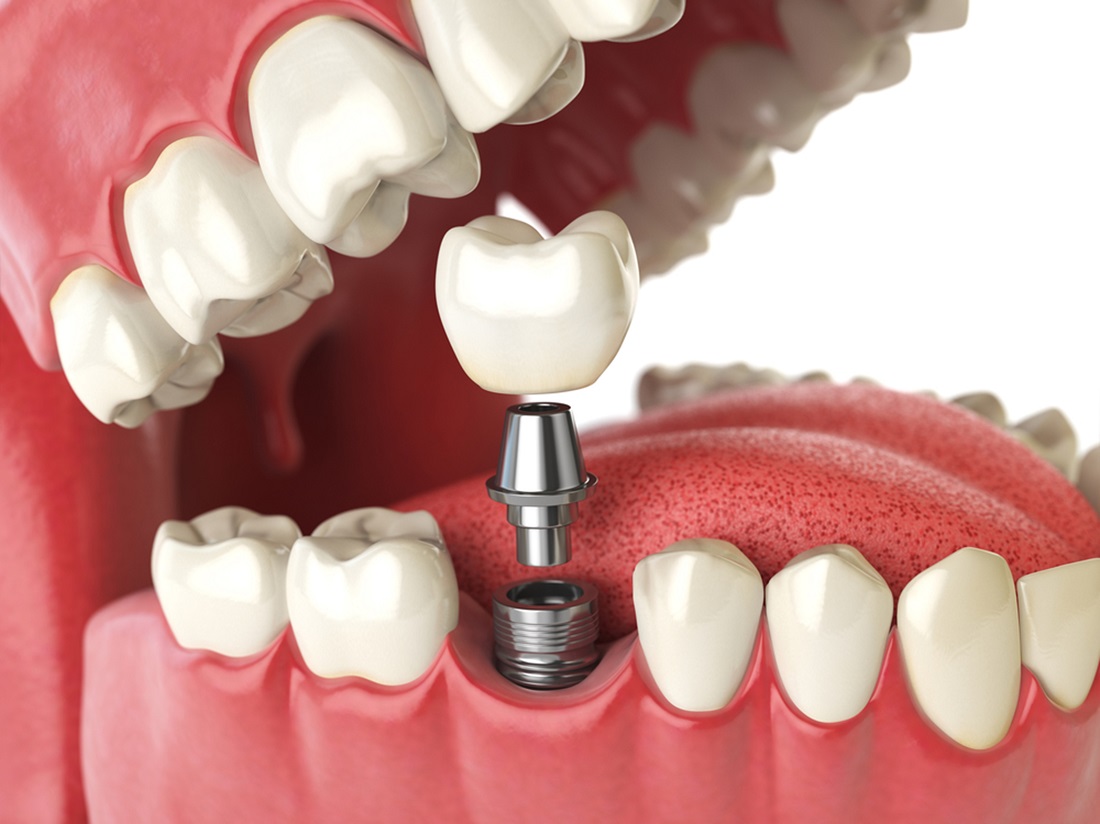 the many benefits of dental implants