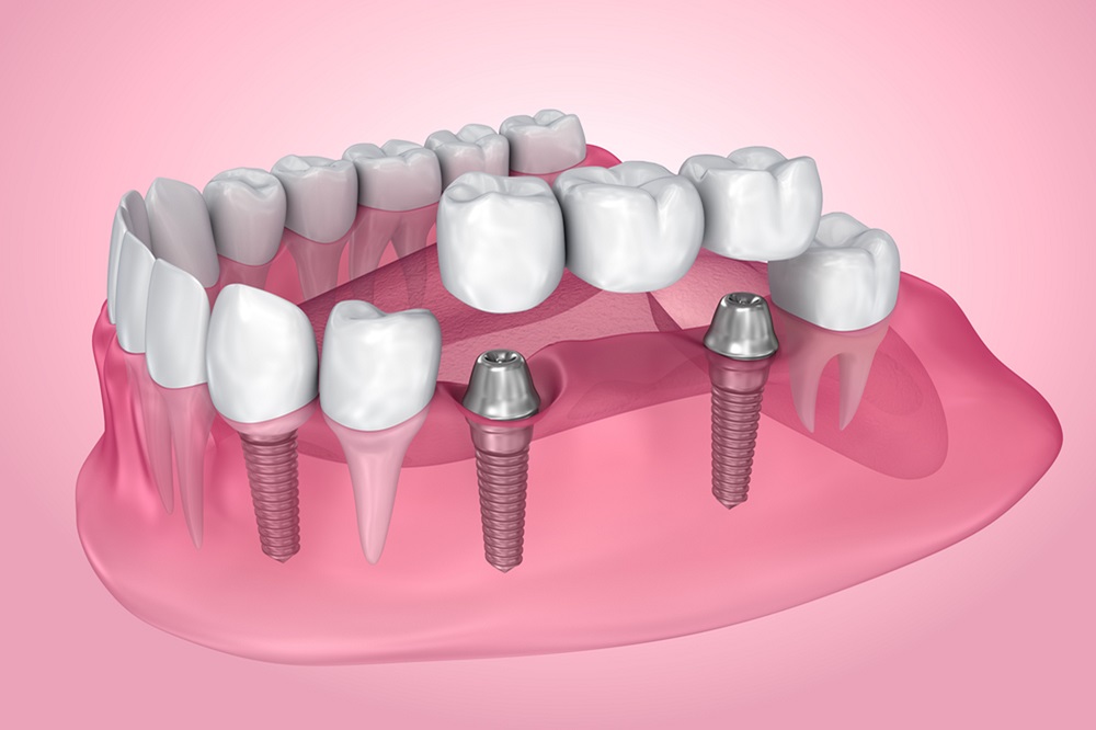 what is the best material for fixed dental bridges