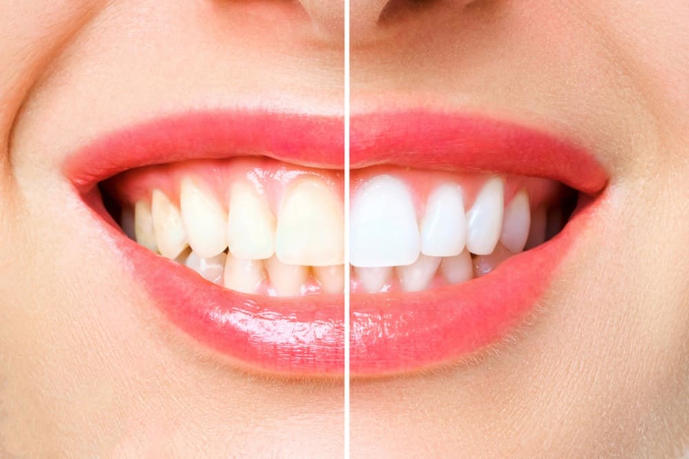 How Long are Teeth Porous After Whitening? Discover the Truth Here!
