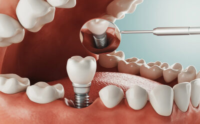 do-gums-grow-around-dental-implants