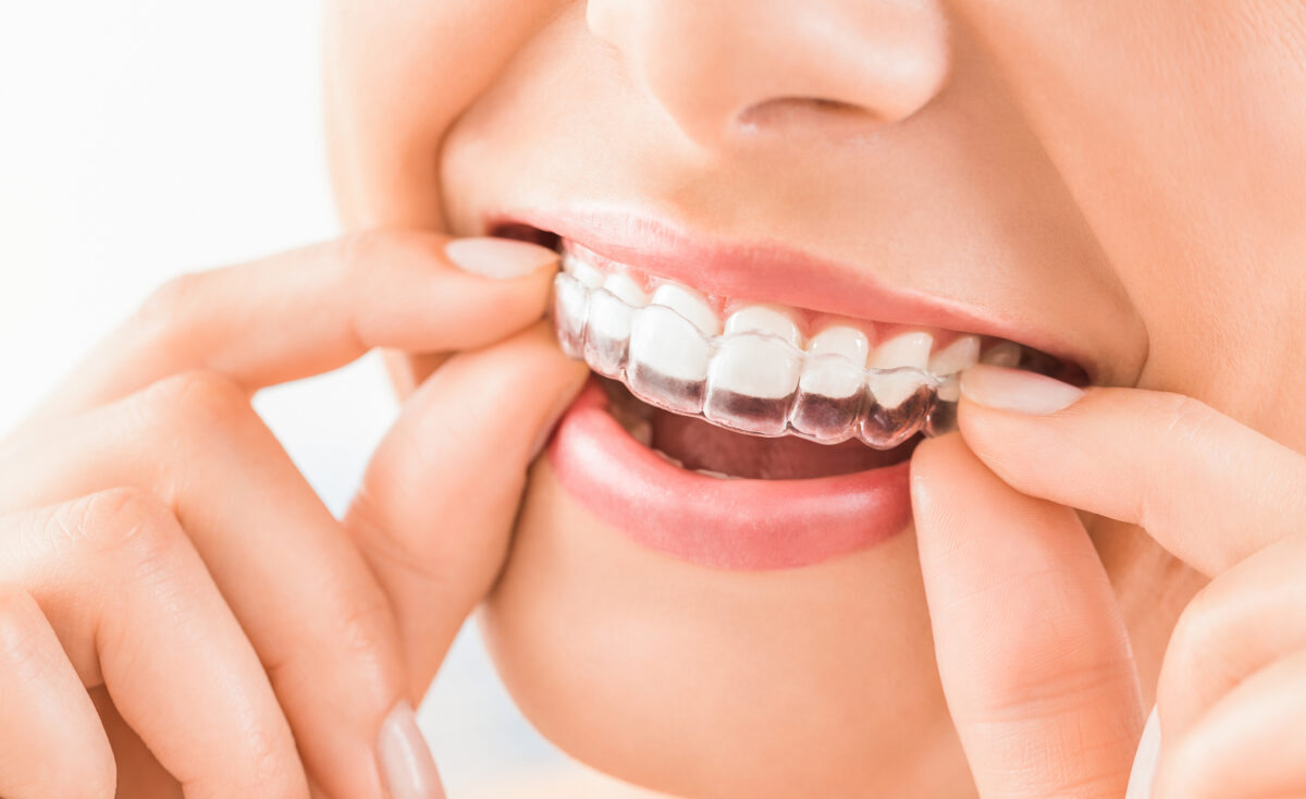 what-are-the-pros-and-cons-of-invisalign